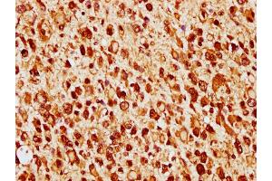 IHC image of nforHU diluted at 1:14 and staining in paraffin-embedded human glioma cancer performed on a Leica BondTM system. (Histone H1.3 抗体  (AA 137-149))