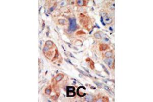 Formalin-fixed and paraffin-embedded human cancer tissue reacted with PIK3CD polyclonal antibody  , which was peroxidase-conjugated to the secondary antibody, followed by DAB staining. (PIK3CD 抗体  (C-Term))