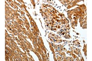 The image on the left is immunohistochemistry of paraffin-embedded Human cervical cancer tissue using ABIN7192428(SLC22A3 Antibody) at dilution 1/25, on the right is treated with synthetic peptide. (SLC22A3 抗体)