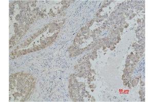 Immunohistochemistry (IHC) analysis of paraffin-embedded Human Lung Carcicnoma using Mouse Monoclonal Antibody diluted at 1:500. (HSP70 抗体)
