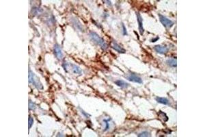 IHC analysis of FFPE human breast carcinoma tissue stained with the ISG15 antibody (ISG15 抗体  (AA 31-61))