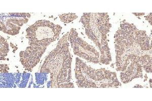 Immunohistochemistry of paraffin-embedded Human lung cancer tissue using CA9 Monoclonal Antibody at dilution of 1:200. (CA9 抗体)