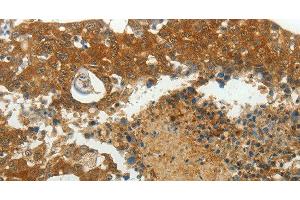 Immunohistochemistry of paraffin-embedded Human breast cancer using MCM4 Polyclonal Antibody at dilution of 1:40 (MCM4 抗体)