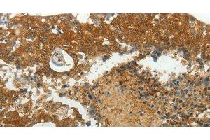 Immunohistochemistry of paraffin-embedded Human breast cancer using MCM4 Polyclonal Antibody at dilution of 1:40 (MCM4 抗体)