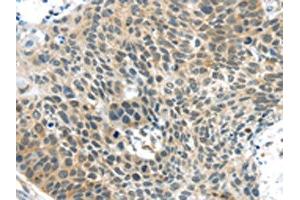 The image on the left is immunohistochemistry of paraffin-embedded Human esophagus cancer tissue using ABIN7192941(TSPY1 Antibody) at dilution 1/40, on the right is treated with synthetic peptide. (TSPY1 抗体)