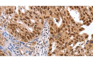 Immunohistochemistry of paraffin-embedded Human ovarian cancer using PARP1 Polyclonal Antibody at dilution of 1:40 (PARP1 抗体)