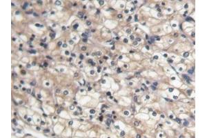 DAB staining on IHC-P; Samples: Human Renal cancer Tissue (BMP7 抗体  (AA 30-431))