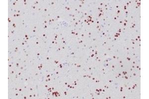 Formalin-fixed, paraffin-embedded human oligodendroglioma stained with OLIG2 Recombinant Rabbit Monoclonal Antibody (OLIG2/6695R). (Recombinant OLIG2 抗体  (AA 200-300))
