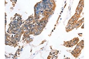 The image on the left is immunohistochemistry of paraffin-embedded Human colon cancer tissue using ABIN7128332(AKR1D1 Antibody) at dilution 1/35, on the right is treated with fusion protein. (AKR1D1 抗体)