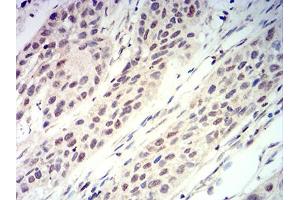 Immunohistochemical analysis of paraffin-embedded esophageal cancer tissues using RUNX3 mouse mAb with DAB staining. (RUNX3 抗体  (AA 294-429))