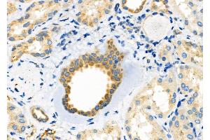 ABIN6265126 and ABIN6272496 at 1/100 staining Human kidney cancer and adjacent normal tissues by IHC-P. (SLC30A2 抗体  (Internal Region))