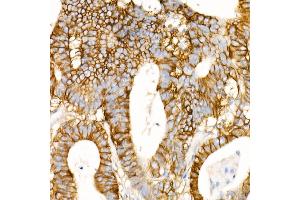 Immunohistochemistry of paraffin-embedded Human colon carcinoma using CD147/BSG antibody (ABIN7265838) at dilution of 1:100 (40x lens). (CD147 抗体)