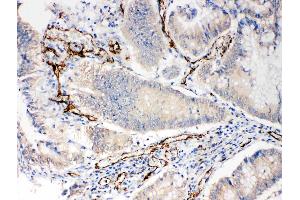Anti-CD31 antibody, IHC(P): Human Intestinal Cancer Tissue (CD31 抗体  (C-Term))