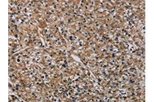 The image on the left is immunohistochemistry of paraffin-embedded Human prostate cancer tissue using ABIN7191019(HSPG2 Antibody) at dilution 1/50, on the right is treated with synthetic peptide. (HSPG2 抗体)