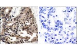 Immunohistochemistry analysis of paraffin-embedded human breast carcinoma tissue, using 4E-BP1 (Ab-36) Antibody. (eIF4EBP1 抗体  (AA 4-53))