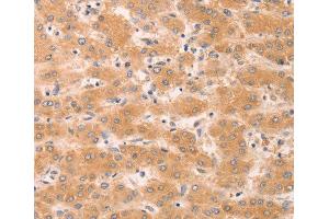 Immunohistochemistry of paraffin-embedded human liver cancer tissue, using GNA11 antibody. (GNA11 抗体)