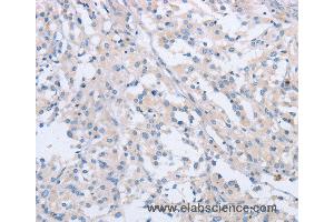 Immunohistochemistry of Human thyroid cancer using AGAP2 Polyclonal Antibody at dilution of 1:60 (AGAP2 抗体)