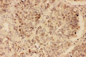 Anti-SOX2 antibody, IHC(P) IHC(P): Human Lung Cancer Tissue (SOX2 抗体  (Middle Region))