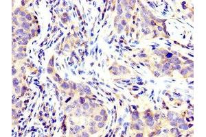 IHC image of ABIN7174344 diluted at 1:200 and staining in paraffin-embedded human pancreatic cancer performed on a Leica BondTM system. (USP48 抗体  (AA 358-508))