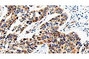 Immunohistochemistry of paraffin-embedded Human lung cancer tissue using COX16 Polyclonal Antibody at dilution 1:50 (COX16 抗体)