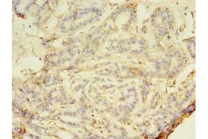 Immunohistochemistry of paraffin-embedded human breast cancer using ABIN7160224 at dilution of 1:100 (SMAD1 抗体  (AA 202-335))