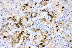 ACSL1 was detected in paraffin-embedded sections of human liver cancer tissues using rabbit anti- ACSL1 Antigen Affinity purified polyclonal antibody (Catalog # ) at 1 µg/mL. (ACSL1 抗体  (AA 604-698))