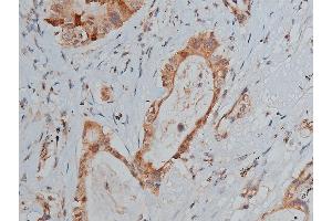 ABIN6267287 at 1/50 staining human lung cancer tissue sections by IHC-P. (p53 抗体  (pSer20))