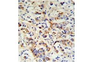 Formalin fixed, paraffin embedded breast carcinoma stained with DCT Antibody (N-term) followed by peroxidase conjugation of the secondary antibody and DAB staining. (DCT 抗体  (N-Term))