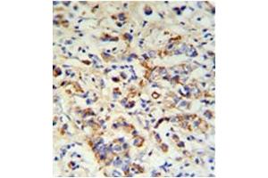 Formalin fixed, paraffin embedded breast carcinoma stained with DCT Antibody (N-term) followed by peroxidase conjugation of the secondary antibody and DAB staining.