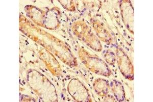 Immunohistochemistry of paraffin-embedded human gastric cancer using ABIN7169664 at dilution of 1:100 (STAT1 抗体  (AA 63-196))