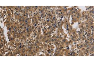 Immunohistochemistry of paraffin-embedded Human liver cancer using KCNMB4 Polyclonal Antibody at dilution of 1:40 (KCNMB4 抗体)