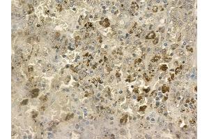 ABIN6258777 and ABIN6273394 at 1/100 staining human melanoma by IHC-P. (CCL24 抗体  (C-Term))