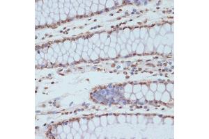 Immunohistochemistry of paraffin-embedded human colon using Phospho-CDK1-Y15 antibody (ABIN3019442, ABIN3019443, ABIN3019444 and ABIN6225371) at dilution of 1:100 (40x lens). (CDK1 抗体  (pTyr15))