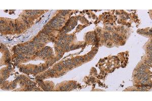 Immunohistochemistry of paraffin-embedded Human gastric cancer tissue using MFAP5 Polyclonal Antibody at dilution 1:40 (MFAP5 抗体)