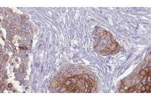 ABIN6277266 at 1/100 staining Human urothelial cancer tissue by IHC-P. (FCGR3A 抗体  (C-Term))