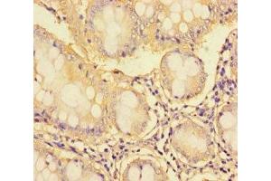 Immunohistochemistry of paraffin-embedded human colon cancer using ABIN7171095 at dilution of 1:100 (SYN1 抗体  (AA 113-420))