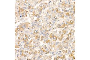 Immunohistochemistry of paraffin-embedded human liver cancer using /AMID Rabbit pAb (ABIN6129888, ABIN6136678, ABIN6136679 and ABIN6215707) at dilution of 1:25 (40x lens). (AIFM2 抗体  (AA 1-373))