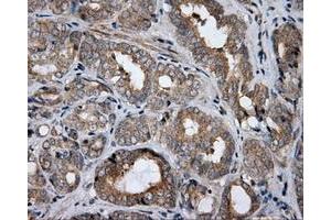 Immunohistochemical staining of paraffin-embedded Adenocarcinoma of colon tissue using anti-HDAC10 mouse monoclonal antibody. (HDAC10 抗体)