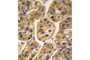 Formalin-fixed and paraffin-embedded human hepatocarcinoma tissue reacted with IDH1 antibody (Center), which was peroxidase-conjugated to the secondary antibody, followed by DAB staining. (Isocitrate Dehydrogenase 抗体  (Middle Region))
