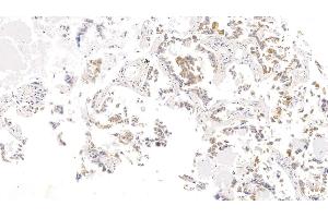 Detection of CK17 in Human Lung cancer Tissue using Monoclonal Antibody to Cytokeratin 17 (CK17) (KRT17 抗体  (AA 252-393))