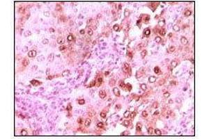 Immunohistochemical analysis of paraffin-embedded human brain glioma tissue showing nuclear localization using calcyclin mouse mAb with DAB staining. (S100A6 抗体)