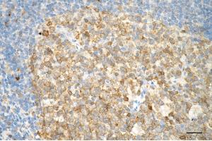 Immunohistochemistry was performed on paraffin-embedded human tonsillitis using caspase 3 antibody (ABIN7797895), 1:200). (Recombinant Caspase 3 抗体)