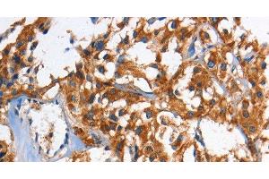 Immunohistochemistry of paraffin-embedded Human thyroid cancer using HK2 Polyclonal Antibody at dilution of 1:60 (Hexokinase 2 抗体)