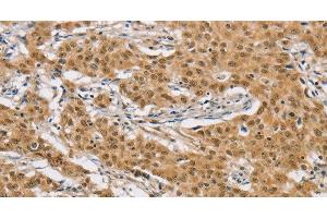 Immunohistochemistry of paraffin-embedded Human gastic cancer using ARHGAP25 Polyclonal Antibody at dilution of 1:40 (ARHGAP25 抗体)