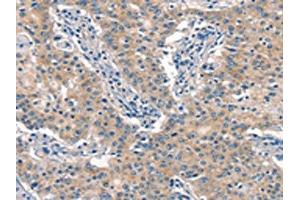 The image on the left is immunohistochemistry of paraffin-embedded Human gastric cancer tissue using ABIN7190538(EID3 Antibody) at dilution 1/15, on the right is treated with synthetic peptide.