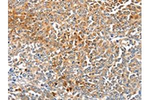 The image on the left is immunohistochemistry of paraffin-embedded Human ovarian cancer tissue using ABIN7191349(MAGEB2 Antibody) at dilution 1/40, on the right is treated with synthetic peptide. (MAGEB2 抗体)