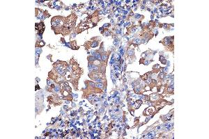 Immunohistochemistry of paraffin-embedded human lung cancer using VPS11 Rabbit mAb (ABIN7271272) at dilution of 1:100 (40x lens). (VPS11 抗体)