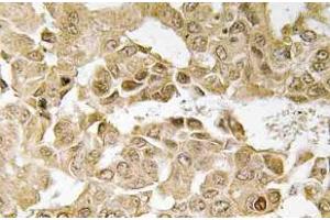 Immunohistochemistry (IHC) analyzes of MEK1 antibody in paraffin-embedded human breast carcinoma tissue. (MEK1 抗体)