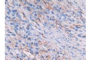 DAB staining on IHC-P; Samples: Human Lung cancer Tissue (HLA-DRB1 抗体  (AA 30-266))