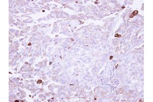 IHC-P Image Immunohistochemical analysis of paraffin-embedded human lung adenocarcinoma Macrophage, using VAP1, antibody at 1:250 dilution. (AOC3 抗体)